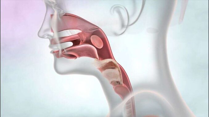 what-is-a-tracheostomy-10-1